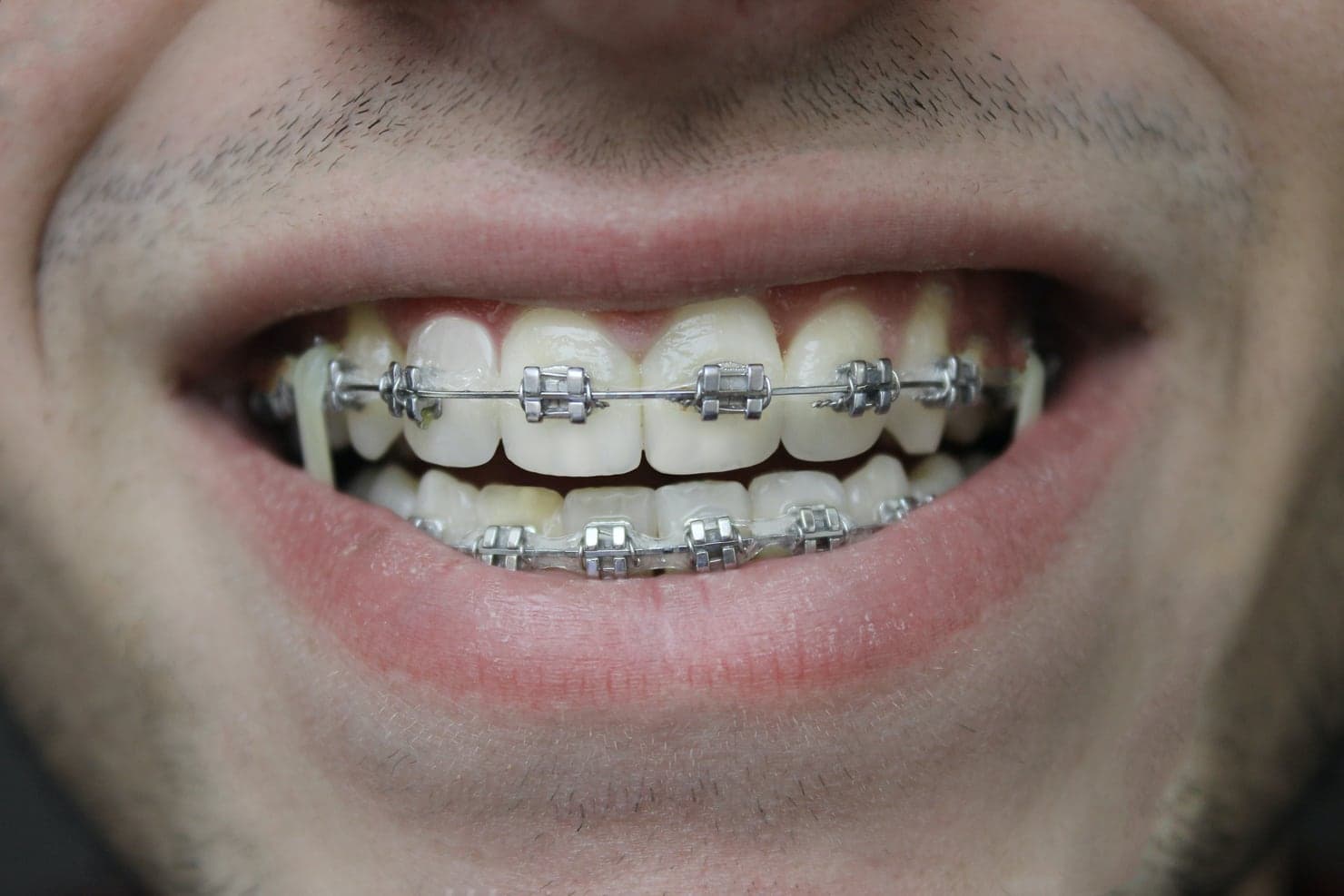 Smile with metal braces