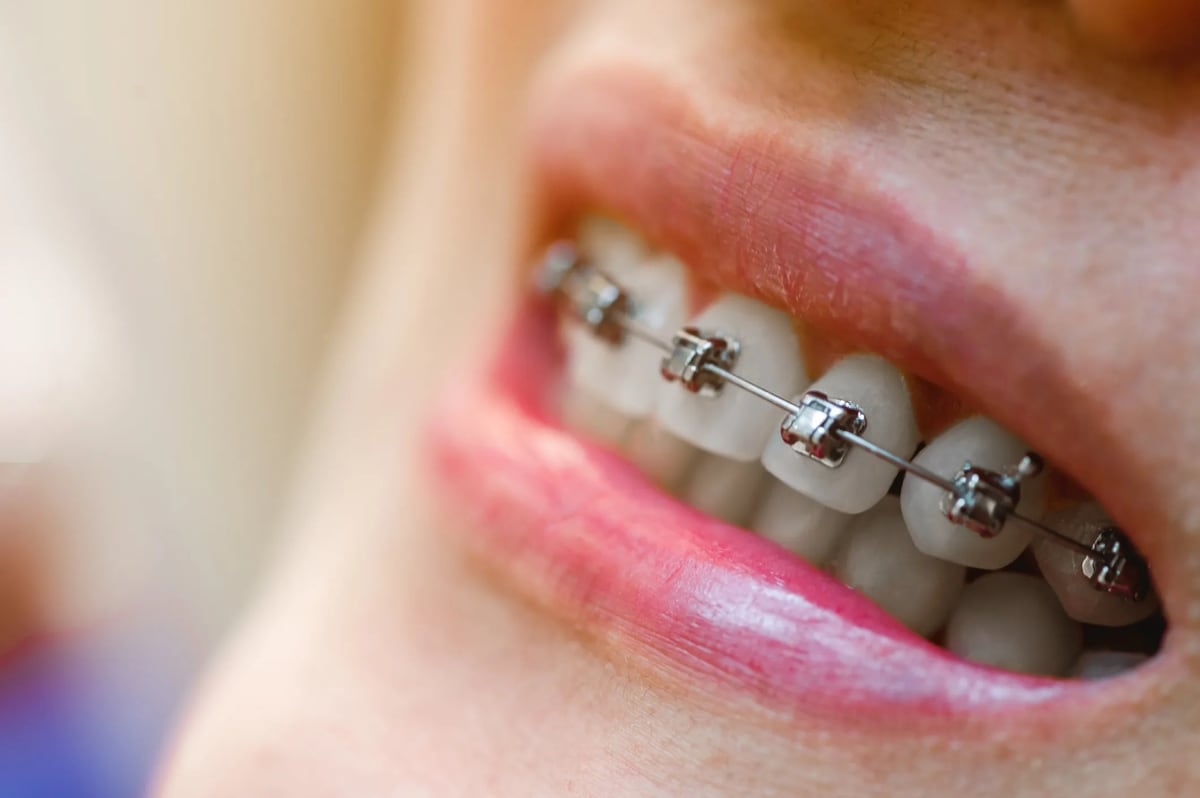 Damon Braces in New Paltz & Kerhonkson, NY - Dr. Pink Orthodontics